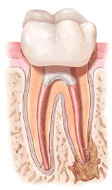 Endodontic Retreatment