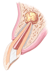 Endodontic Surgery